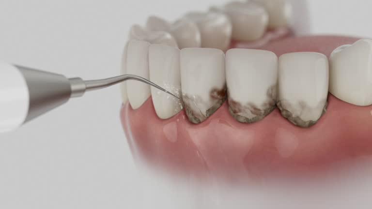 Reliable Teeth Whitening contractor in Boyce, LA by Smile Center Dentistry